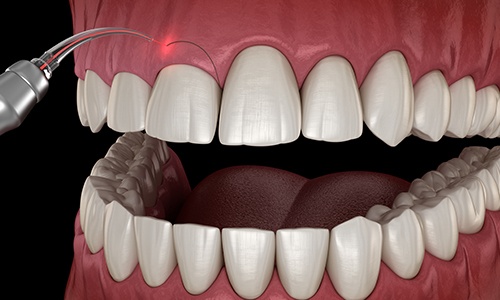 Animated smile during laser gum recontouring treatment