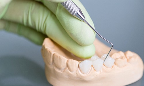 Webster dentist pointing to model of dental bridge