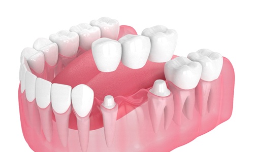 Illustration of traditional dental bridge Webster