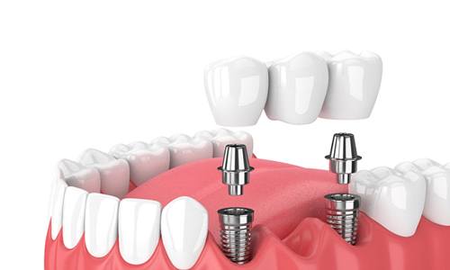 Illustration of implant bridge in Webster