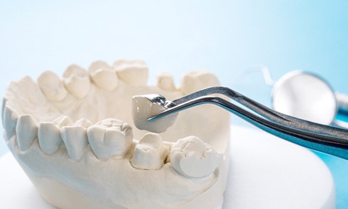 Webster dentist placing dental crown on model of teeth