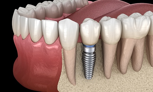 Animated smile with dental implant supported dental crown