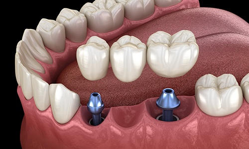 Animated dental implant supported fixed bridge