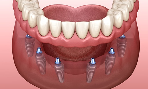 Animated dental implant supported denture