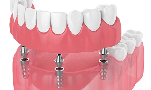 Diagram of an implant denture in Webster on white background
