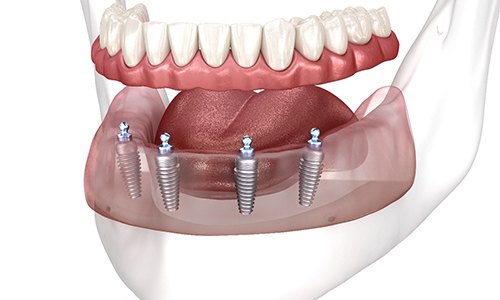 a graphic of implant dentures being placed