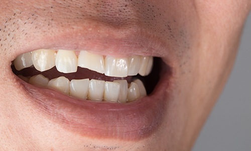 Closeup of smile with chipped top front tooth