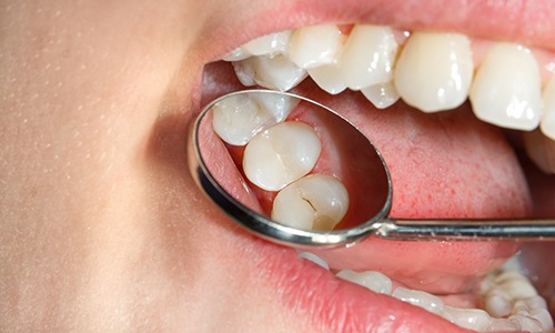 Closeup of an open mouth with tooth-colored fillings in Webster 