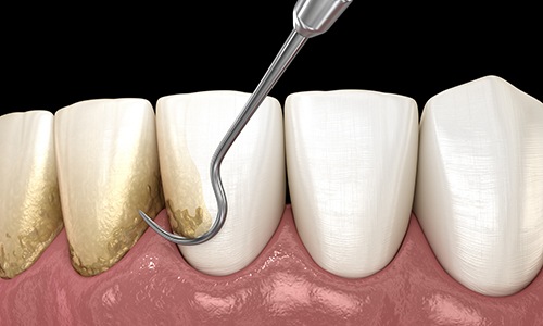 Animated smile during scaling and root planing periodontal therapy