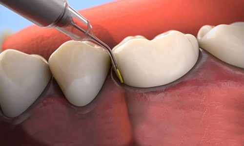 Animated smile during antibiotic therapy