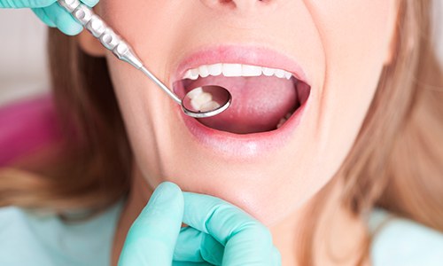Closeup of patient receiving preventive dental checkup and teeth cleaning