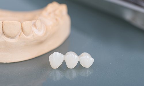 Model smile sitting on table beside dental bridge restoration