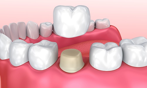Animated smile with a dental crown restoration
