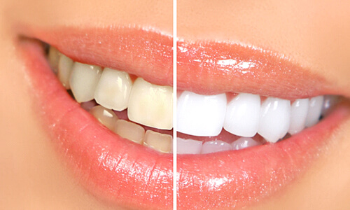 before and after comparison of teeth whitening in Webster