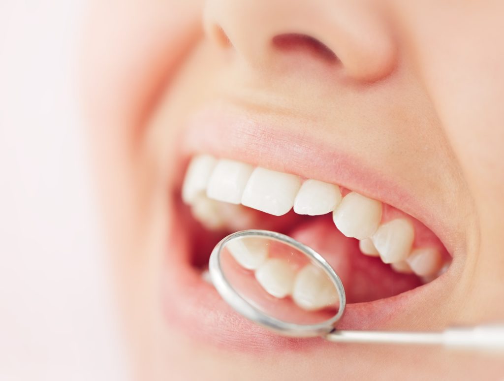 Dental mirror examining tooth-colored filling